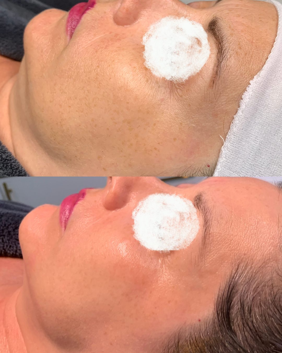 Wrinkle and anti-aging treatment