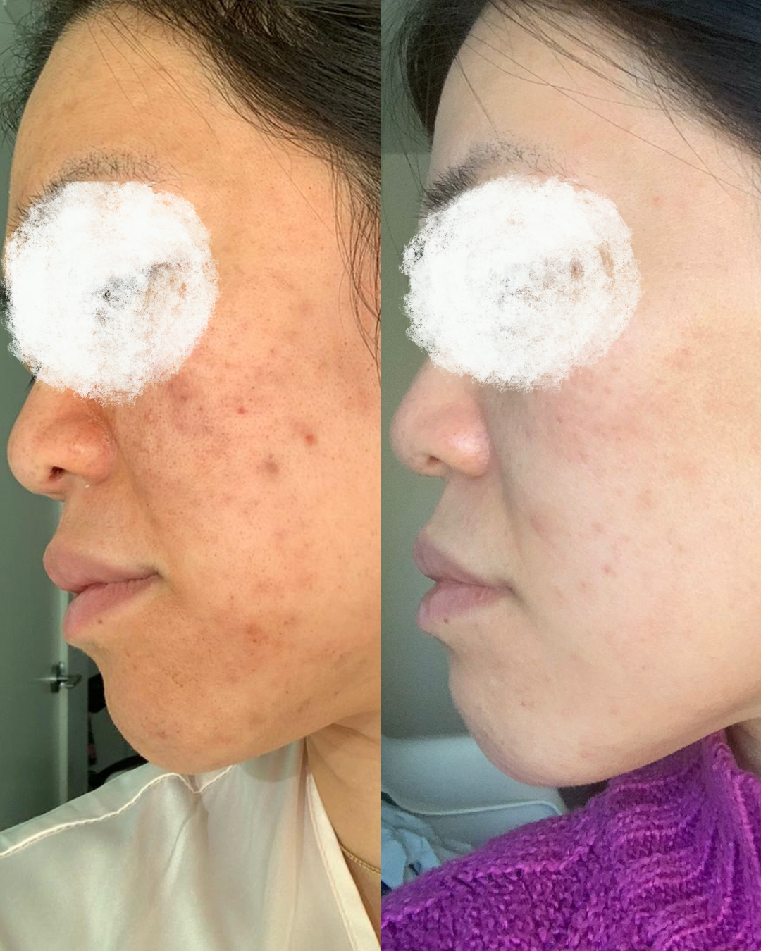 Combination - Cosmelan, Microneedling and DPC Acne - Acne & Pigmentation Treatment