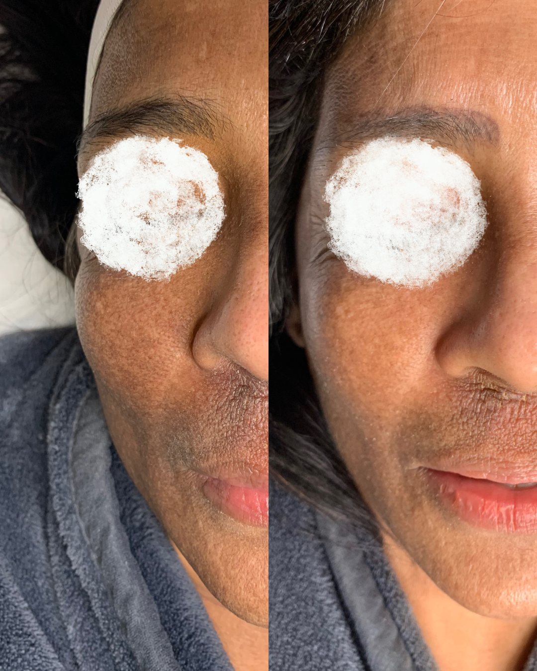 Combination - Laser Pigmentation & Skin Rejuvenation & Cosmelan