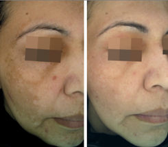 Cosmelan - Pigmentation Condition