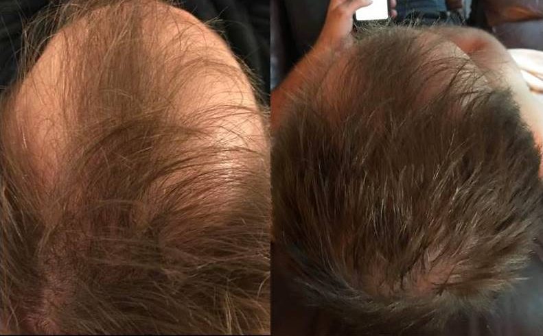 Hair Loss Therapy 1