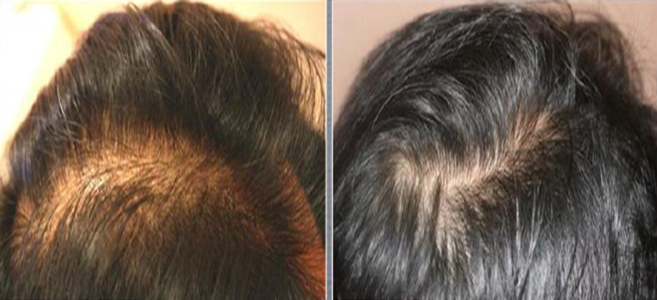Hair Loss Therapy 3