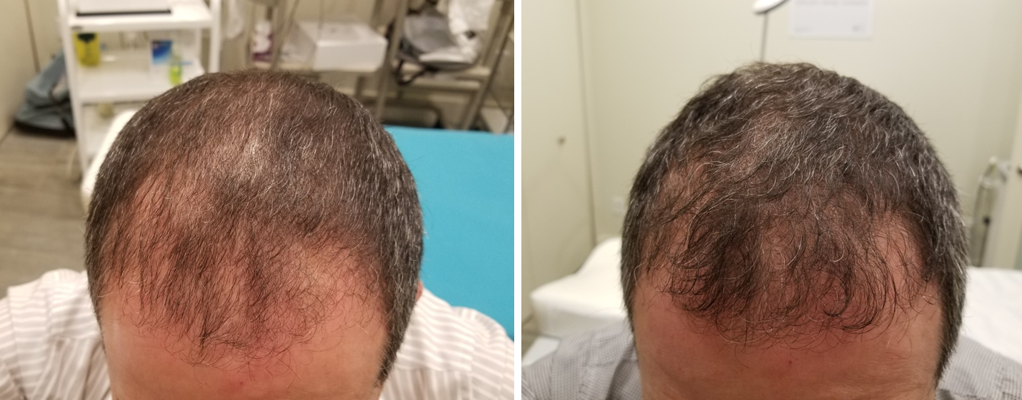 Hair Loss Therapy 4