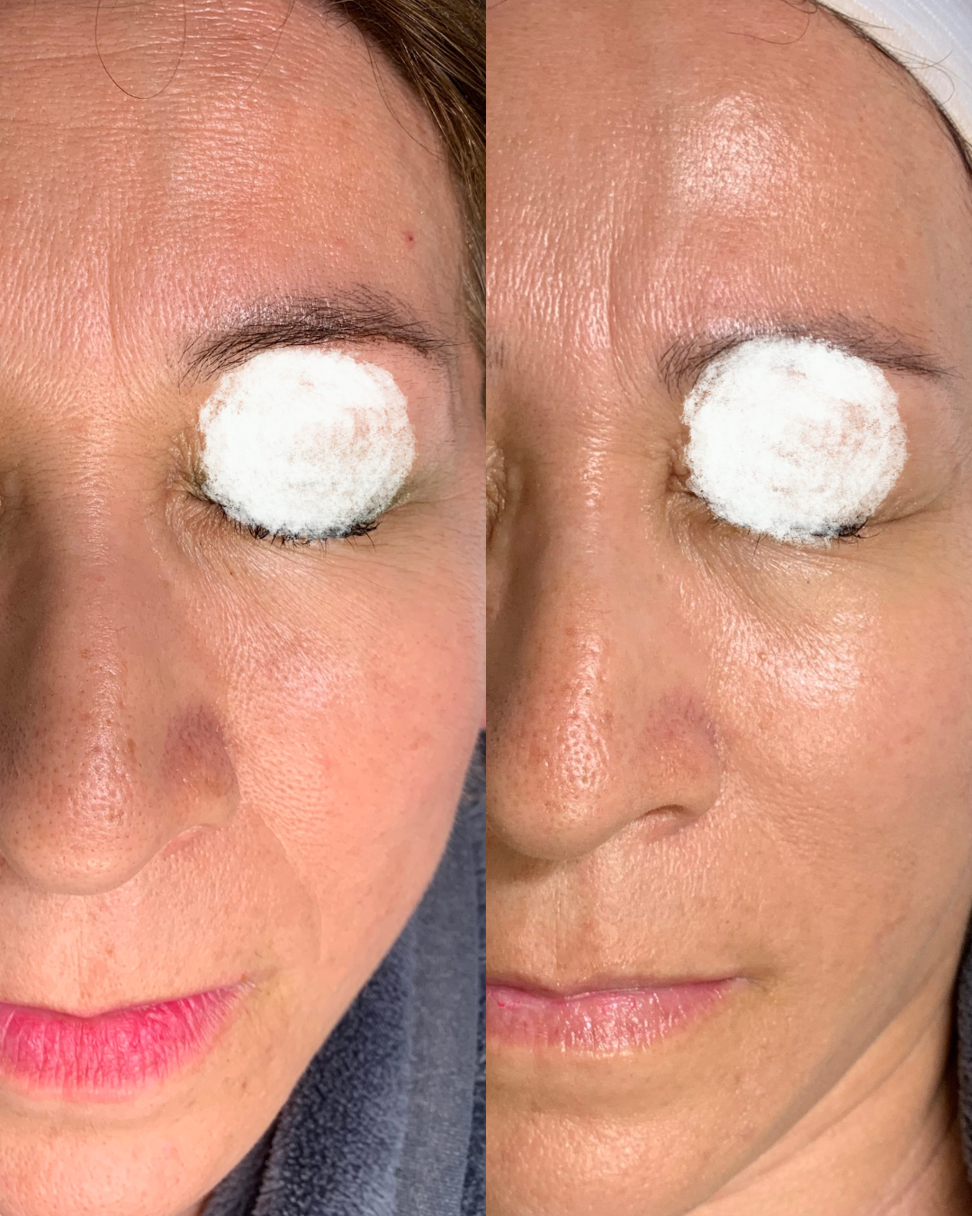 Lase Skin Rejuvenation - Wrinkle Condition