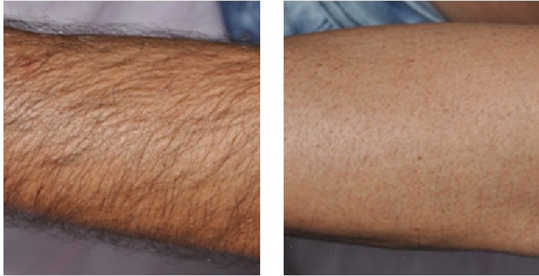 Laser Hair Removal