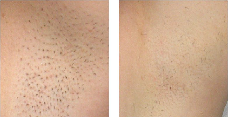 Laser Hair Removal-2