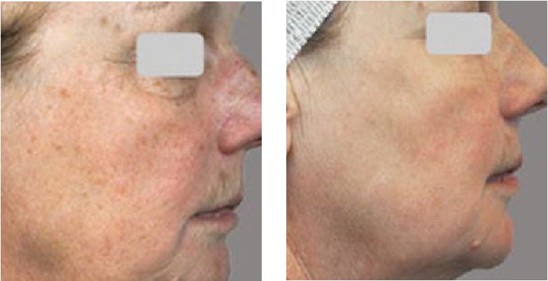 Laser Skin Rejuvenation & Pigmentation Laser - Wrinkles and Vascular Condition1