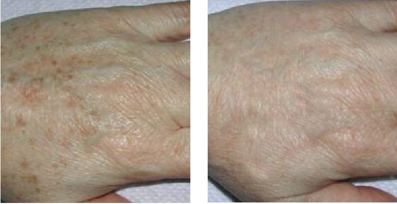 Laser Skin Rejuvenation & Vascular & Pigmentation Treatment