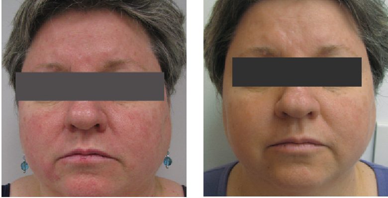 Laser Skin Rejuvenation & Vascular and Pigmentation DPC 1