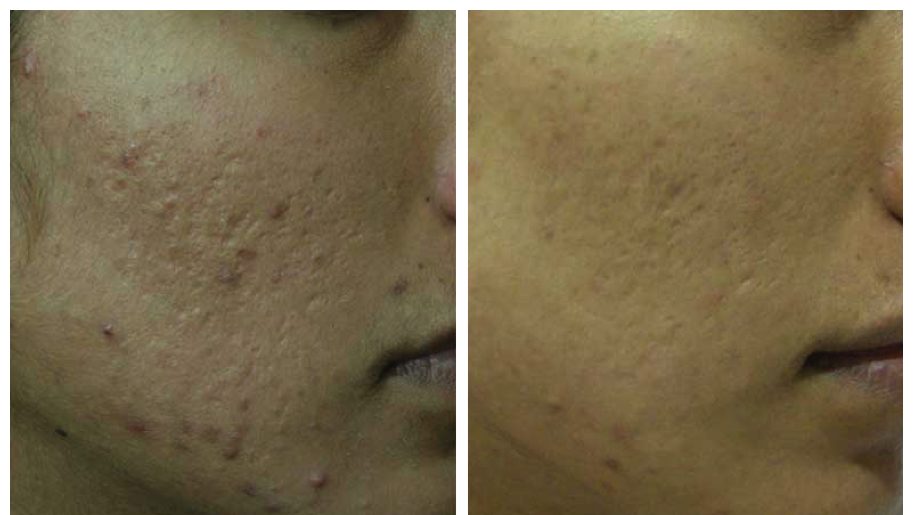 Microneedling Acne