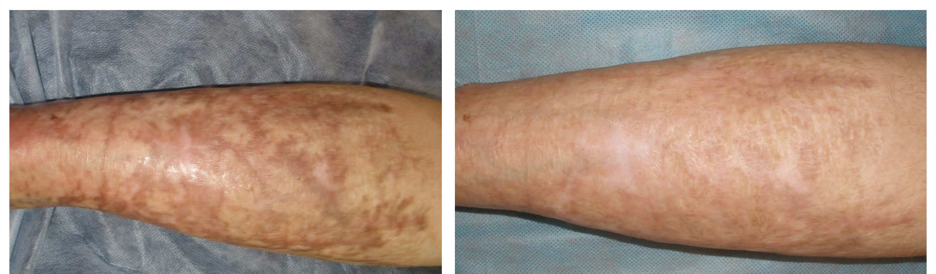 Microneedling - Burn Scars