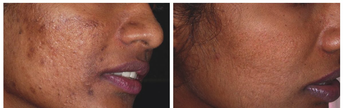 Microneedling - Hyperpigmentation Condition as well