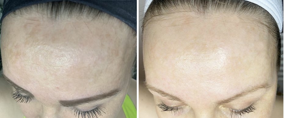 Microneedling - Pigmentation Condition
