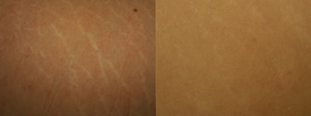 Microneedling- Stretch Marks