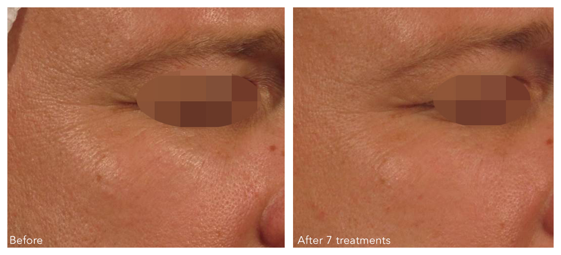 OxyGeneo-Tripollar Skin Tightening