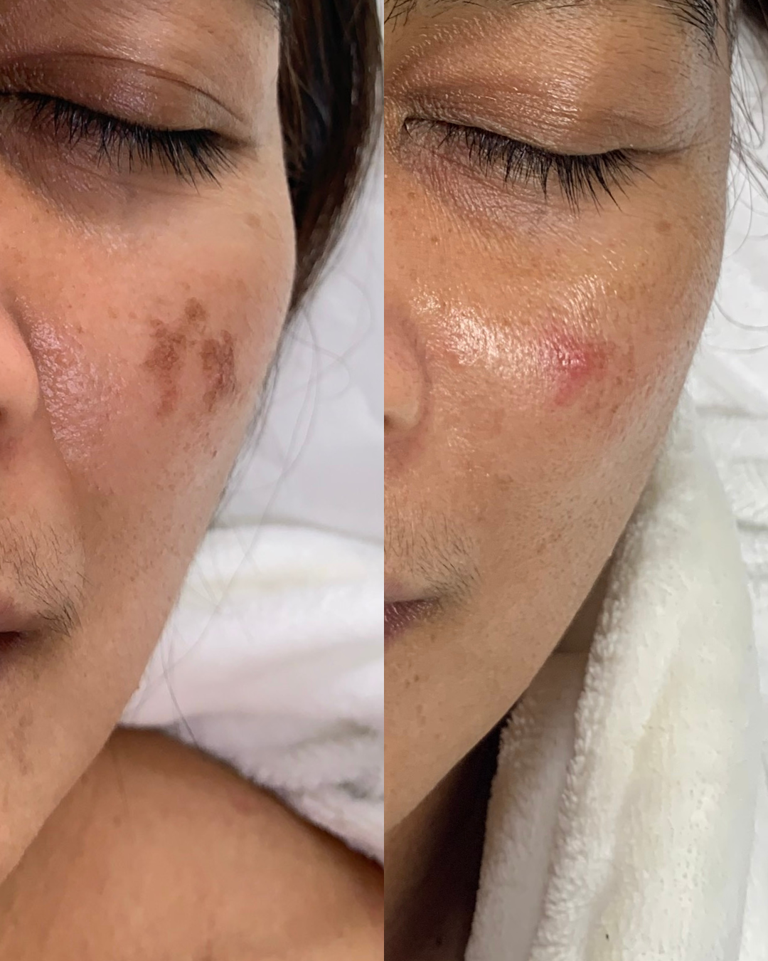 Pigmentation Treatment3