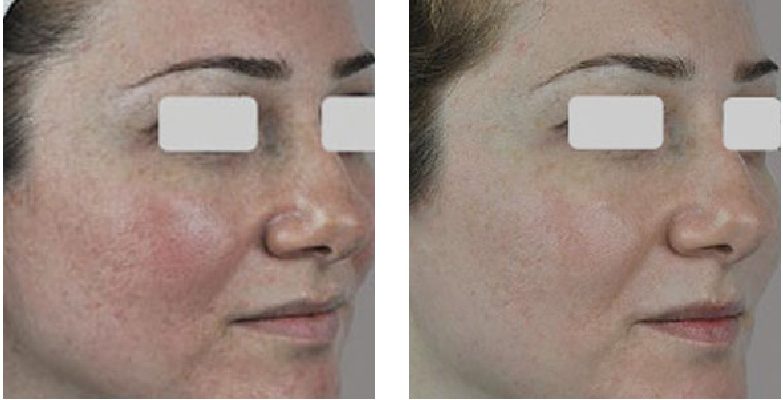 Skin Rejuvenation and Vascular Treatment2