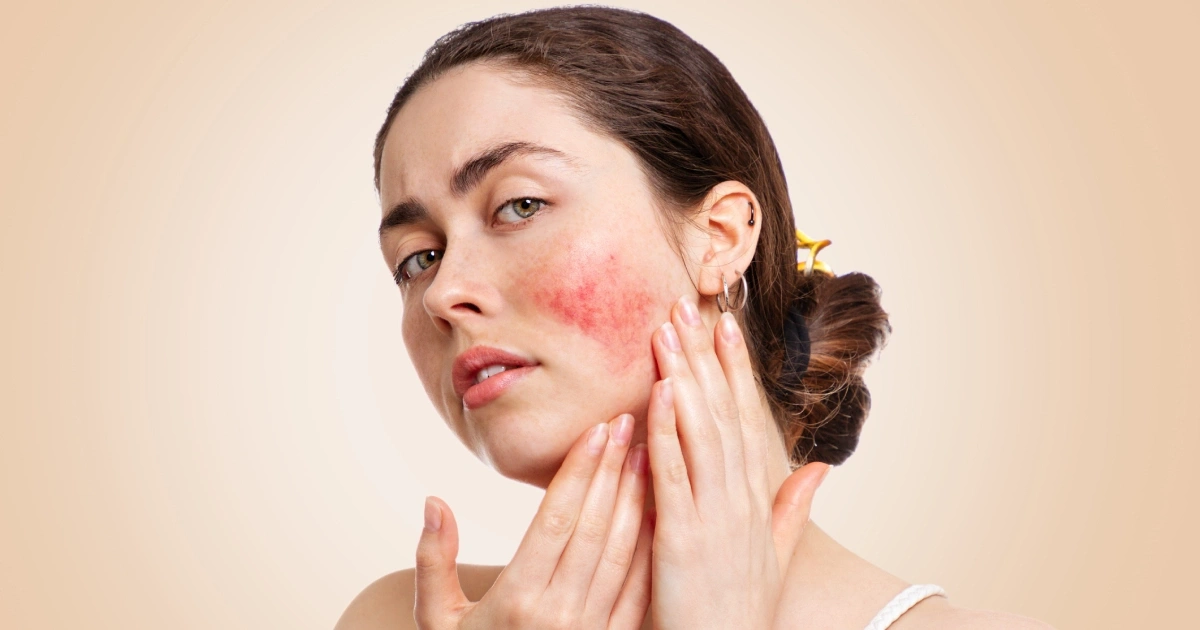 Facial redness from rosacea in Ontario on woman’s cheek.