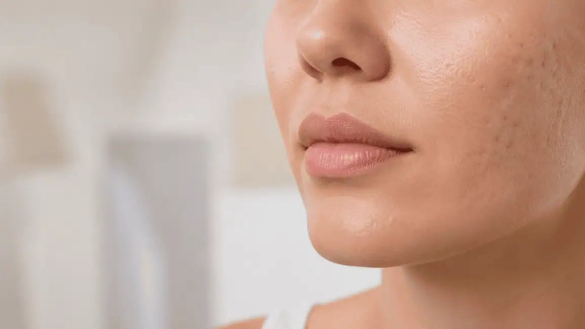 Close-up of clear facial skin with subtle healed acne scars on one cheek, representing acne scar treatment and skin texture improvement in a professional skincare setting.