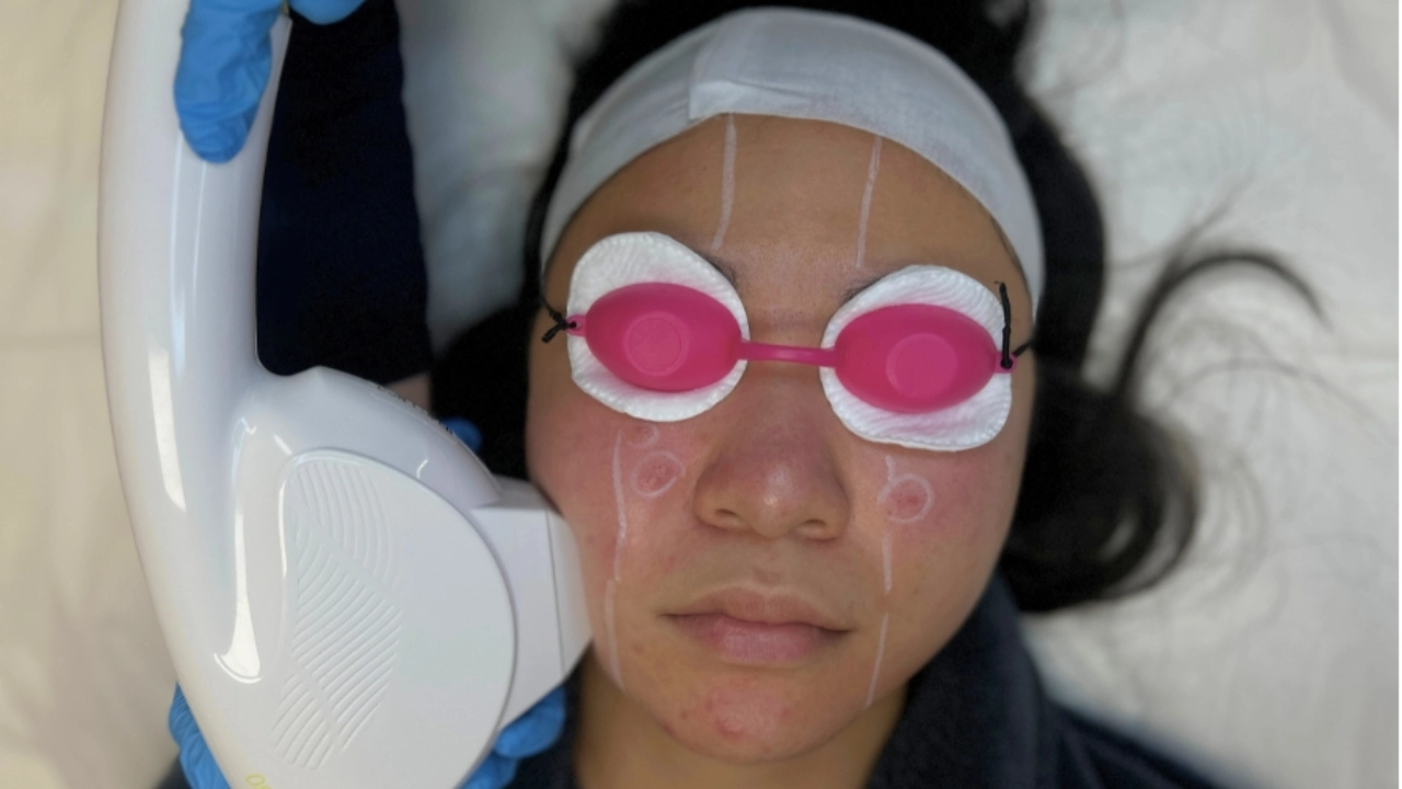 Adult acne treatment in Toronto
